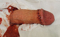 Circumcision Adult Male 6