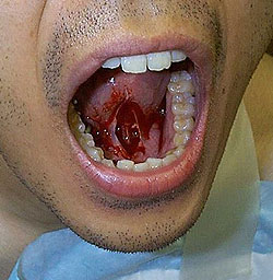 File:TongueFrenectomy.jpg