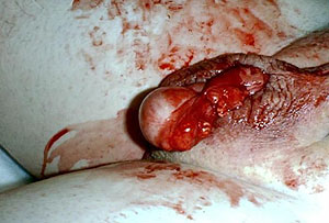 Human male castration