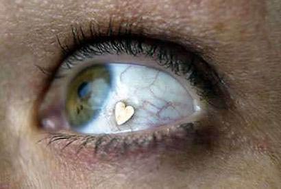 File:Eyeball Implant-1.jpg