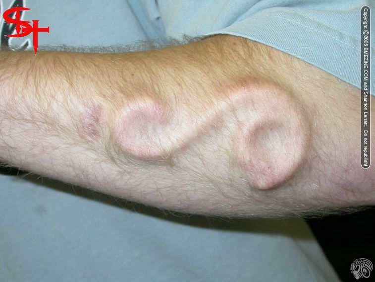 File:Arm-Implant-1.jpg