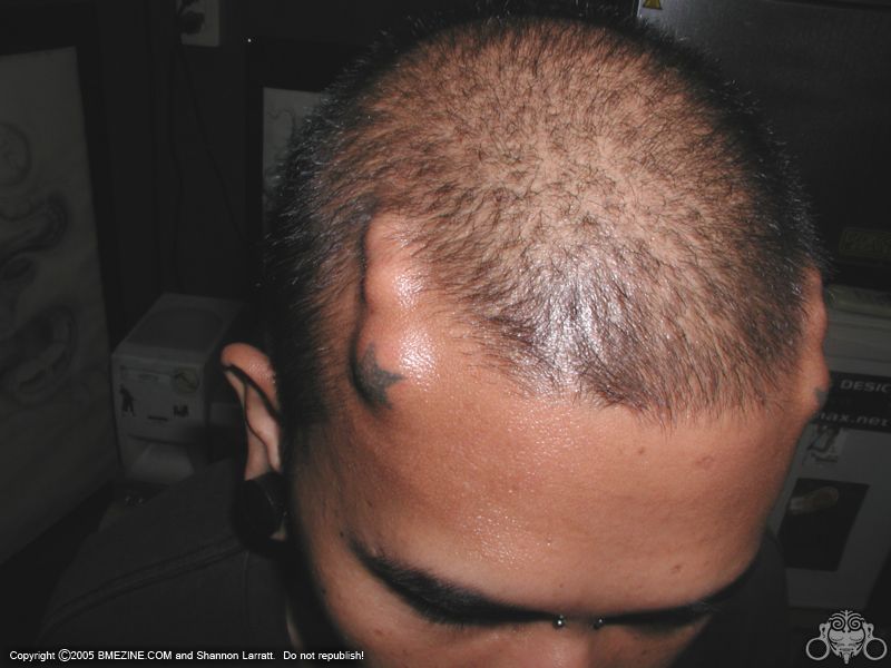 File:Forehead-Implant-1.jpg