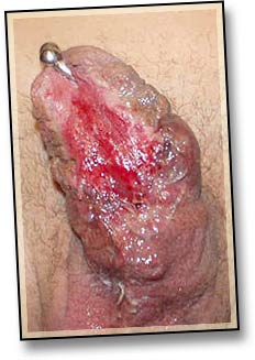 Penis splitting related infection-1.jpg