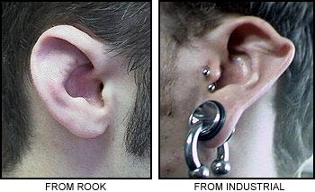 File:Ear Collapse-1.jpg