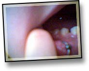 File:Tooth Drift-1.jpg