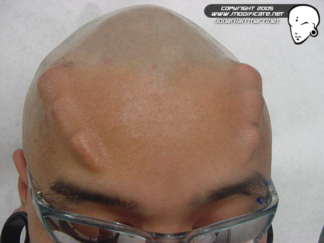 File:Foreheadimplantjonathan.jpg