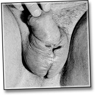 File:Scrotal Infection-1.jpg