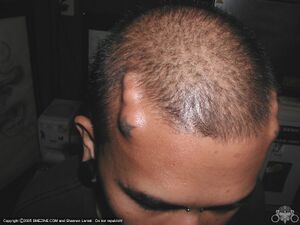 Forehead-Implant-1.jpg