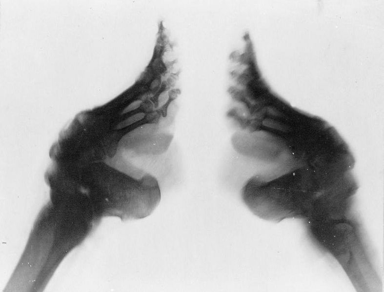 File:Bound feet (X-ray).jpg