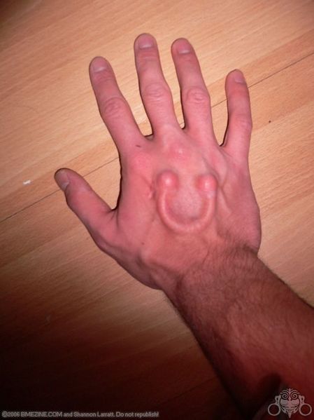 File:Hand-Implant-1.jpg