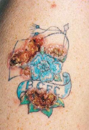 Tattoo Ink Eaten By Macrophages : Shots - Health News : NPR