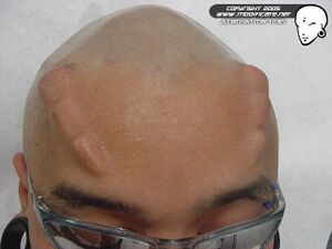 Foreheadimplantjonathan.jpg